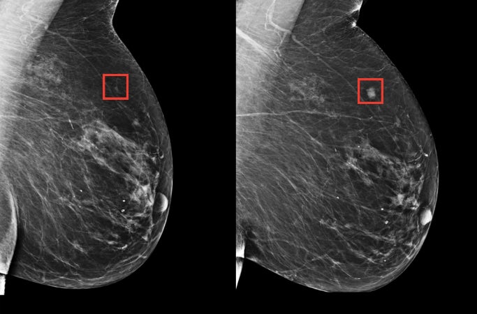 深度学习9万张乳房X光照后 AI模型可预测未来5年是否恶化为乳腺癌