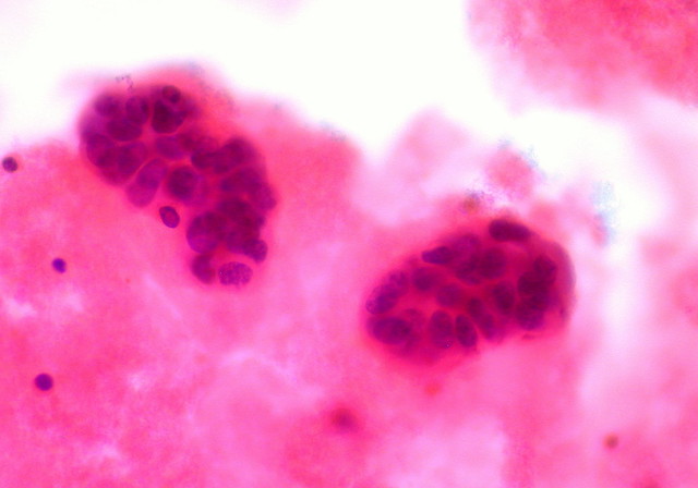 研究：肠道微生物混乱会加速乳腺癌的转移扩散