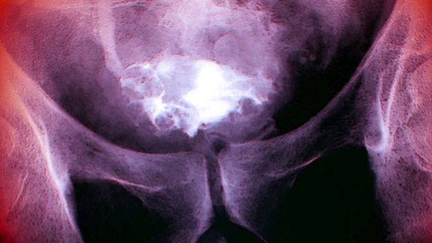 研究发现普通感冒病毒可以感染并杀死膀胱癌细胞