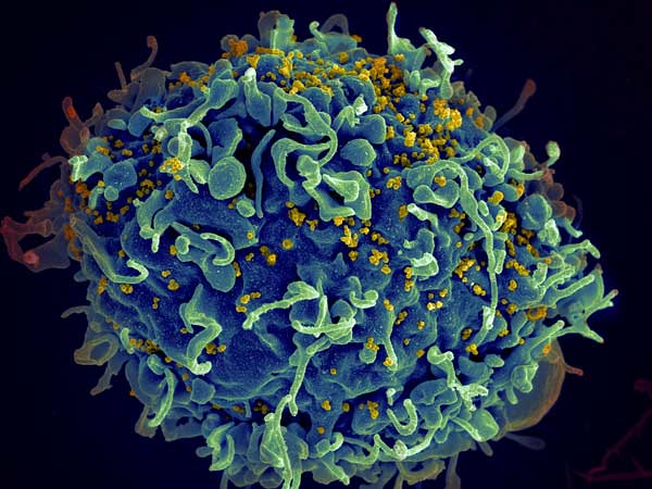 研究发现对感染HIV的新生儿进行抗逆转录病毒治疗越早越好